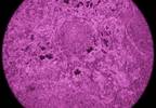 FDA Issues Advisory for Increased Risk of Lymphoma in Patients Treated With Golimumab FDA Issues Advisory for Increased Risk of Lymphoma in Patients Treated With Golimumab