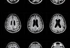 TNF-Inhibition for Treatment of Arthritis Increases Risk of Multiple Sclerosis TNF-Inhibition for Treatment of Arthritis Increases Risk of Multiple Sclerosis