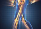 Chondrocalcinosis Not Associated With Distinct Radiographic Phenotype in Knee, Hip OA Chondrocalcinosis Not Associated With Distinct Radiographic Phenotype in Knee, Hip OA