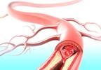 SLE Associated With Elevated Risk for Atherosclerosis SLE Associated With Elevated Risk for Atherosclerosis