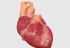 Do Your Patients With RA Have Asymptomatic LV Systolic Dysfunction? Do Your Patients With RA Have Asymptomatic LV Systolic Dysfunction?