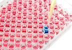 Shared Etiologic Inflammatory Link in Pediatric KD, Adult KLS Shared Etiologic Inflammatory Link in Pediatric KD, Adult KLS