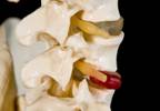 Does Invasive Provocative Discography Increase Risk of Disc Degeneration? Does Invasive Provocative Discography Increase Risk of Disc Degeneration?