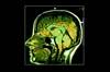 Peripheral Inflammatory Markers Are Associated With Psychomotor Retardation in Major Depressive Disorder Peripheral Inflammatory Markers Are Associated With Psychomotor Retardation in Major Depressive Disorder