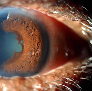Abnormal Chest Radiograph in Uveitis Often Sarcoidosis Abnormal Chest Radiograph in Uveitis Often Sarcoidosis