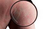 How Dermatologists Can Help Address Gaps in the Diagnosis of Psoriatic Arthritis How Dermatologists Can Help Address Gaps in the Diagnosis of Psoriatic Arthritis