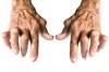 Dose-Dependent ACR20 Response Rates in RA With Peficitinib Dose-Dependent ACR20 Response Rates in RA With Peficitinib