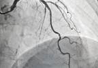 Addressing the Lack of Validated Risk Calculators for CVD in RA Addressing the Lack of Validated Risk Calculators for CVD in RA