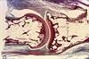 Rheumatoid Arthritis Treatment Initiated Early on Shows Good Long-Term Outcomes Rheumatoid Arthritis Treatment Initiated Early on Shows Good Long-Term Outcomes