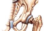 FDA Approves Abaloparatide for Fragility Fracture in Postmenopausal Osteoporosis FDA Approves Abaloparatide for Fragility Fracture in Postmenopausal Osteoporosis
