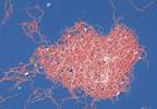 New-Onset Autoimmune Arthritides After Lyme Disease New-Onset Autoimmune Arthritides After Lyme Disease