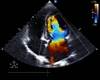 Updated EULAR Guidelines for RA CVD Risk Management Updated EULAR Guidelines for RA CVD Risk Management