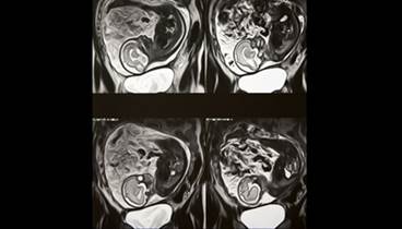 ATA Guidelines for Managing Subclinical Hypothyroidism During Pregnancy: Update ATA Guidelines for Managing Subclinical Hypothyroidism During Pregnancy: Update