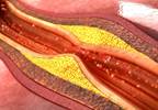 CVD Risks in SLE Mitigated With Counseling Program CVD Risks in SLE Mitigated With Counseling Program