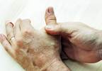 Arthritis Disability Up 20% Since 2002, Says CDC Report Arthritis Disability Up 20% Since 2002, Says CDC Report