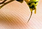 Case: PsA Development After Multiple Wasp Stings Case: PsA Development After Multiple Wasp Stings