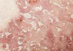 Patients With Psoriatic Arthritis Experience Higher Fatigue Patients With Psoriatic Arthritis Experience Higher Fatigue
