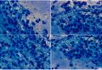 Etanercept for Rheumatoid Arthritis Has Lower Infection Risk Etanercept for Rheumatoid Arthritis Has Lower Infection Risk