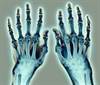 Increased Risk for Diabetes in Patients With Poorly Controlled Rheumatoid Arthritis Increased Risk for Diabetes in Patients With Poorly Controlled Rheumatoid Arthritis