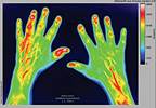 Measuring Disease Activity in Psoriatic Arthritis Measuring Disease Activity in Psoriatic Arthritis