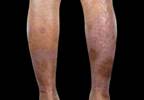 Risk for Endocrine Comorbidities Increased in Psoriatic Arthritis Risk for Endocrine Comorbidities Increased in Psoriatic Arthritis