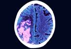 Relative Risk of Ischemic Stroke Doubled in Systemic Lupus Erythematosus Relative Risk of Ischemic Stroke Doubled in Systemic Lupus Erythematosus