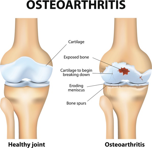 Popping Joints Associated With Knee Osteoarthritis