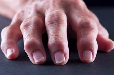 Long-term type 1 diabetes not associated with hand osteoarthritis Long-term type 1 diabetes not associated with hand osteoarthritis