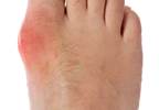 DASH Diet May Help Lower Occurrence of Gout DASH Diet May Help Lower Occurrence of Gout