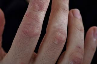 Serum amyloid A levels were significantly correlated with C-reactive protein levels in psoriatic arthritis. Serum amyloid A levels were significantly correlated with C-reactive protein levels in psoriatic arthritis.