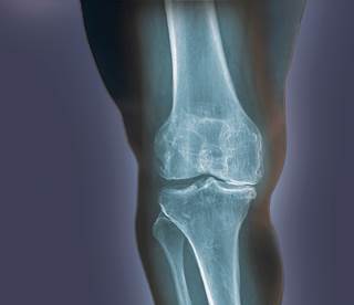 Chondroitin sulfate proved equivalent to celecoxib for osteoarthritis of the knee. Chondroitin sulfate proved equivalent to celecoxib for osteoarthritis of the knee.