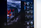 Arterial Function in Patients With RA Consistently Associated With Cardiovascular Risk Factors Arterial Function in Patients With RA Consistently Associated With Cardiovascular Risk Factors