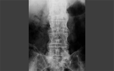 Markers of Radiographic Spinal Progression in Ankylosing Spondylitis Markers of Radiographic Spinal Progression in Ankylosing Spondylitis