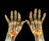 Case Study: Cardiac Manifestations of Rheumatoid Arthritis Case Study: Cardiac Manifestations of Rheumatoid Arthritis
