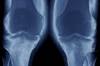 Positive Psychological Intervention Effective on Osteoarthritis Positive Psychological Intervention Effective on Osteoarthritis