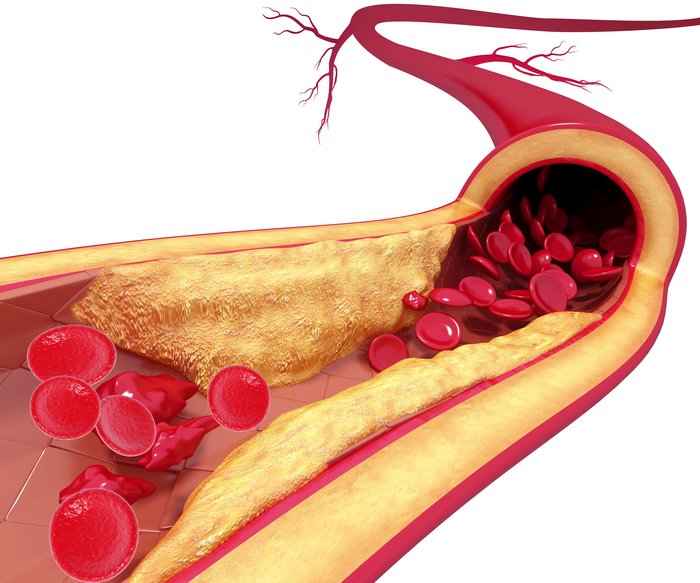 predictors-of-accelerated-atherosclerosis-in-spondyloarthritis-without