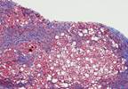 Noninvasive Test Monitors Hepatic Fibrosis in Psoriasis Patients Taking Methotrexate Noninvasive Test Monitors Hepatic Fibrosis in Psoriasis Patients Taking Methotrexate