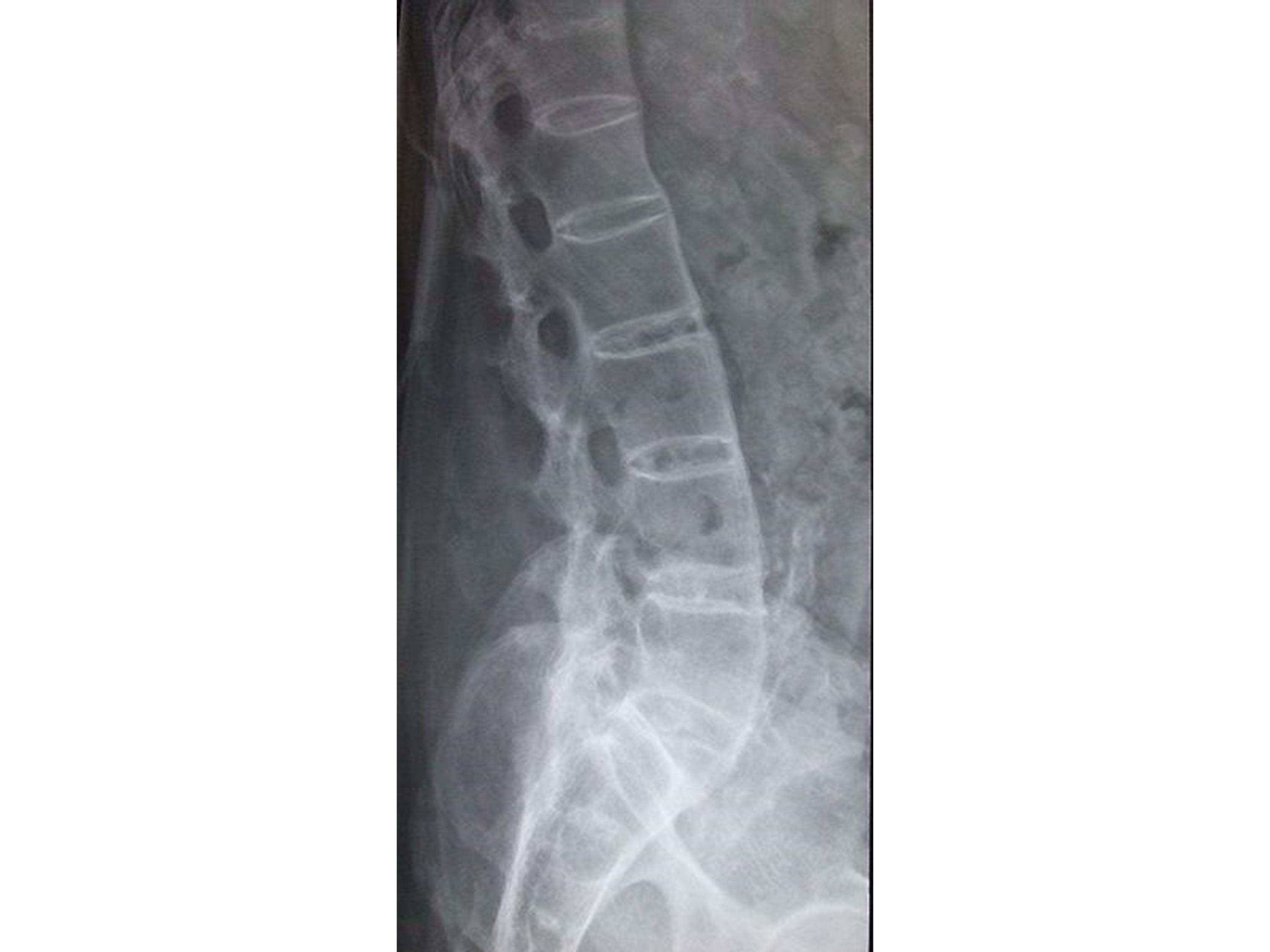 Ankylosing Spondylitis