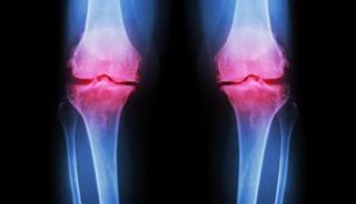 Bisphosphonates did not provide symptomatic relief nor defer radiographic progression of knee osteoarthritis in this study. Bisphosphonates did not provide symptomatic relief nor defer radiographic progression of knee osteoarthritis in this study.