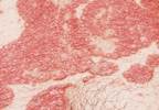 Immunologic Advances Reveal New Targets in Psoriasis and Psoriatic Arthritis Immunologic Advances Reveal New Targets in Psoriasis and Psoriatic Arthritis