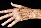 Anti-Tumor Necrosis Factor Drug Improves CV Health in Psoriatic Arthritis Anti-Tumor Necrosis Factor Drug Improves CV Health in Psoriatic Arthritis
