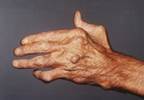 Serotonin Plays Fundamental Role in Rheumatoid Arthritis Serotonin Plays Fundamental Role in Rheumatoid Arthritis