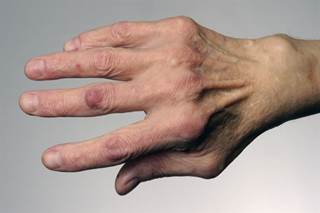 The dorsal 4-finger technique is a reliable method to examine metacarpophalangeal joints in rheumatoid arthritis. <i>Credit: SPL/Science Source</i> The dorsal 4-finger technique is a reliable method to examine metacarpophalangeal joints in rheumatoid arthritis. <i>Credit: SPL/Science Source</i>