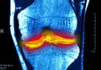 What is the Most Effective NSAID to Relieve Knee OA Pain? What is the Most Effective NSAID to Relieve Knee OA Pain?