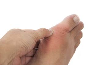 Of the 232 participants that experienced a gout event during the 5 year follow-up, 81 were assigned to the fenofibrate group. Of the 232 participants that experienced a gout event during the 5 year follow-up, 81 were assigned to the fenofibrate group.