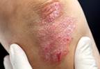 Adalimumab Biosimilar ABP 501 Safe, Effective for Psoriasis Adalimumab Biosimilar ABP 501 Safe, Effective for Psoriasis