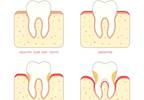 Tocilizumab Improved Periodontal, Rheumatologic Parameters in Patients With RA Tocilizumab Improved Periodontal, Rheumatologic Parameters in Patients With RA