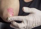 Golimumab Improves Long-Term Radiographic Outcomes in Psoriatic Arthritis Golimumab Improves Long-Term Radiographic Outcomes in Psoriatic Arthritis