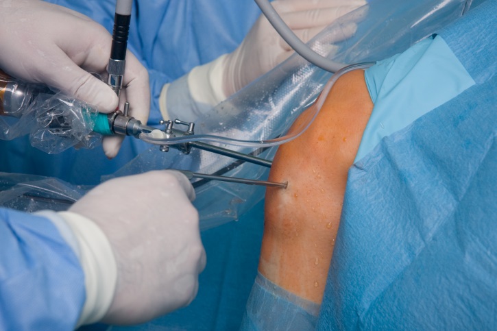 Recovery Time For Arthroscopic Knee Surgery For Torn Cartilage