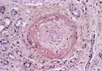 Case Study and Clinical Highlight: Diagnosis of Pulmonary Involvement in Systemic Sclerosis Case Study and Clinical Highlight: Diagnosis of Pulmonary Involvement in Systemic Sclerosis